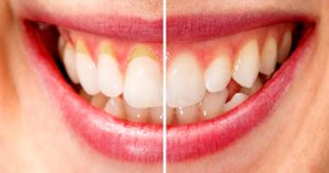 Receding Gums VS Normal