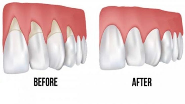 Gentle And Effective Solutions For Gum Health Restoration | Natural Remedies For Receding Gum Line Receding Gums fix themselves